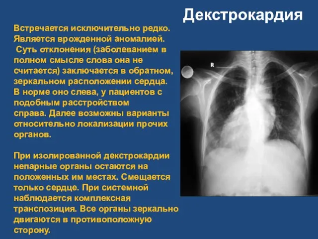 Декстрокардия Встречается исключительно редко. Является врожденной аномалией. Суть отклонения (заболеванием в полном