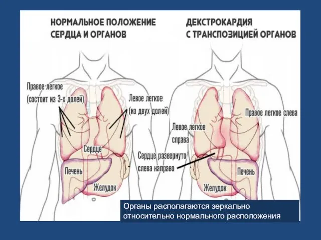 Органы располагаются зеркально относительно нормального расположения