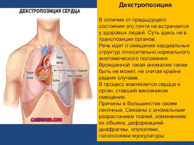 Декстропозиция В отличие от предыдущего состояния это почти не встречается у здоровых