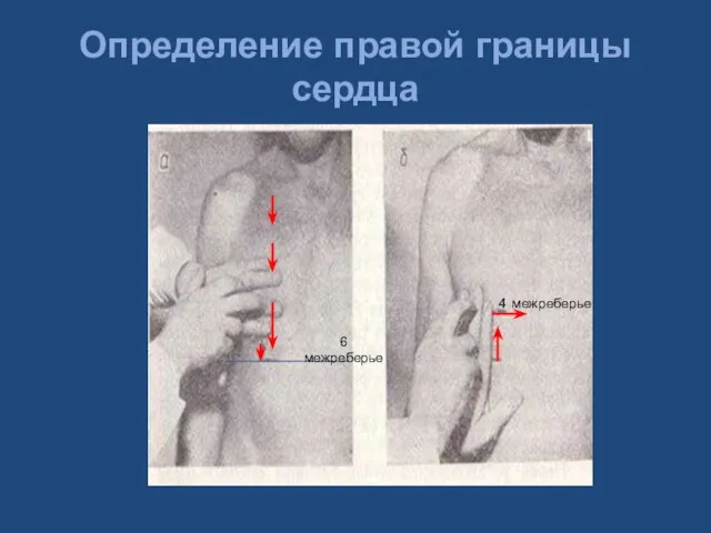 Определение правой границы сердца 6 межреберье 4 межреберье