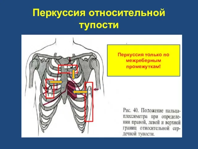 Перкуссия относительной тупости Перкуссия только по межреберным промежуткам!