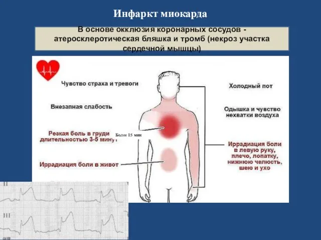 Инфаркт миокарда Более 15 мин В основе окклюзия коронарных сосудов - атеросклеротическая