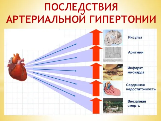 ПОСЛЕДСТВИЯ АРТЕРИАЛЬНОЙ ГИПЕРТОНИИ