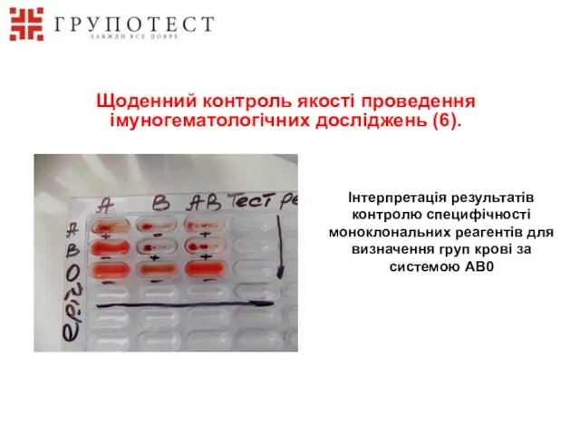 Інтерпретація результатів контролю специфічності моноклональних реагентів для визначення груп крові за системою АВ0