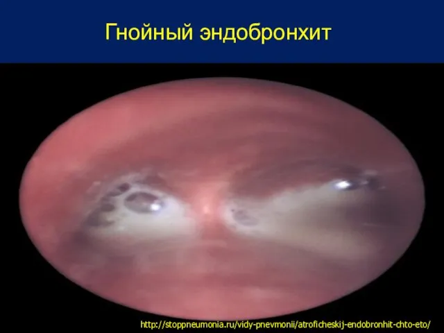 Гнойный эндобронхит http://stoppneumonia.ru/vidy-pnevmonii/atroficheskij-endobronhit-chto-eto/