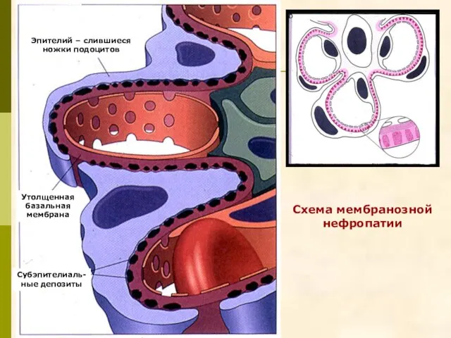 Эпителий – слившиеся ножки подоцитов Субэпителиаль- ные депозиты Утолщенная базальная мембрана Схема мембранозной нефропатии