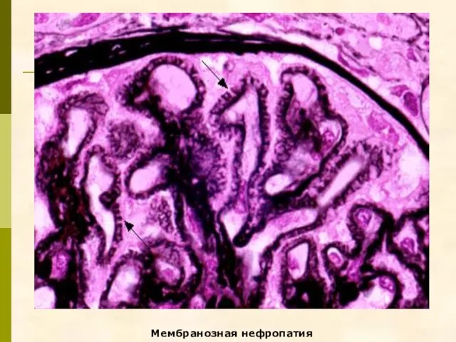 Мембранозная нефропатия