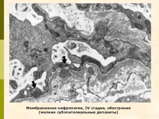 Мембранозная нефропатия, IV стадия, обострение (мелкие субэпителиальные депозиты)