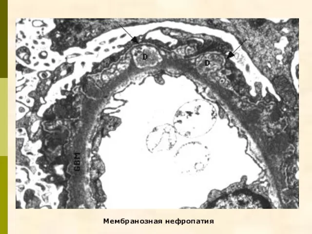 Мембранозная нефропатия