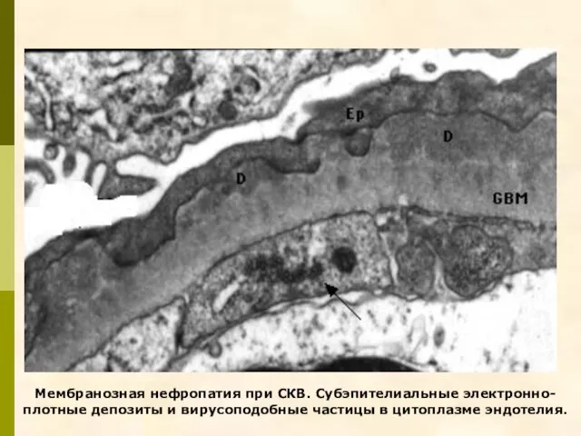 Мембранозная нефропатия при СКВ. Субэпителиальные электронно-плотные депозиты и вирусоподобные частицы в цитоплазме эндотелия.