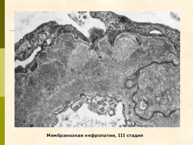 Мембранозная нефропатия, III стадия