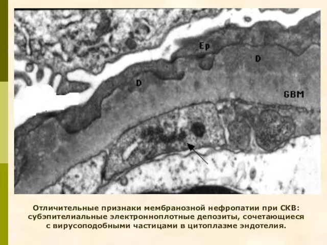 Отличительные признаки мембранозной нефропатии при СКВ: субэпителиальные электронноплотные депозиты, сочетающиеся с вирусоподобными частицами в цитоплазме эндотелия.