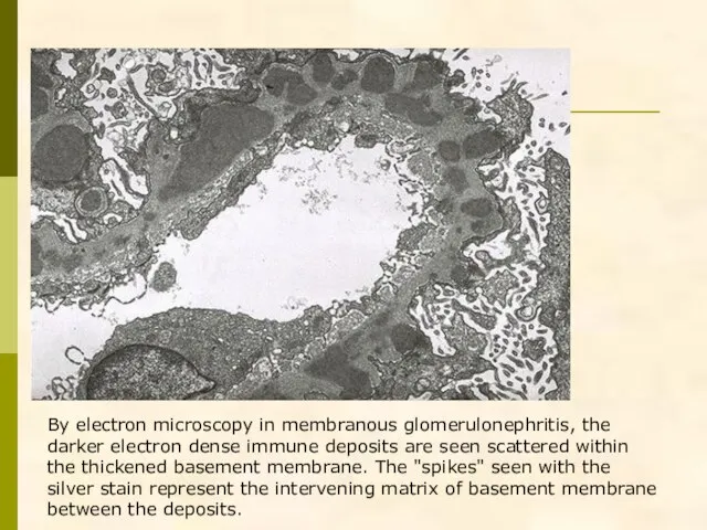 By electron microscopy in membranous glomerulonephritis, the darker electron dense immune deposits
