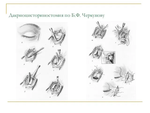 Дакриоцисториностомия по Б.Ф. Черкунову