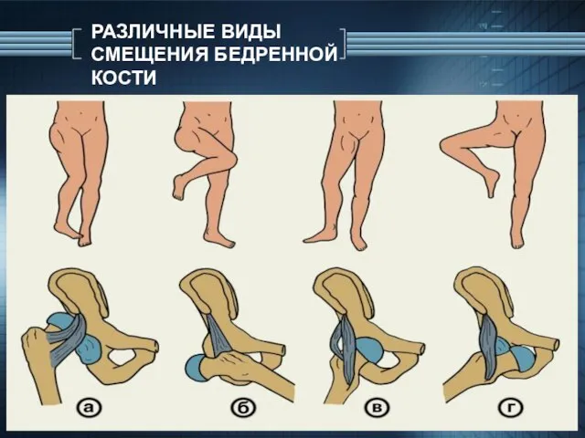 РАЗЛИЧНЫЕ ВИДЫ СМЕЩЕНИЯ БЕДРЕННОЙ КОСТИ