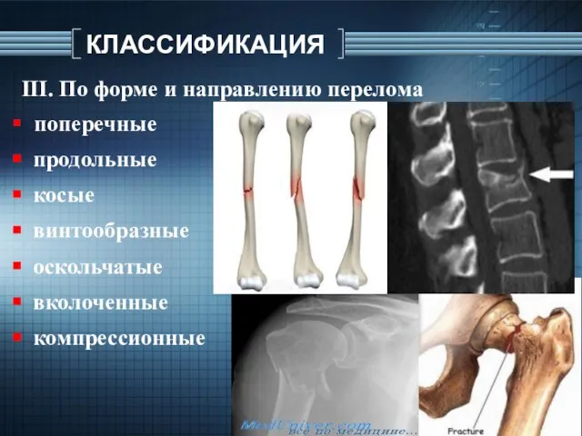 КЛАССИФИКАЦИЯ ІІІ. По форме и направлению перелома поперечные продольные косые винтообразные оскольчатые вколоченные компрессионные