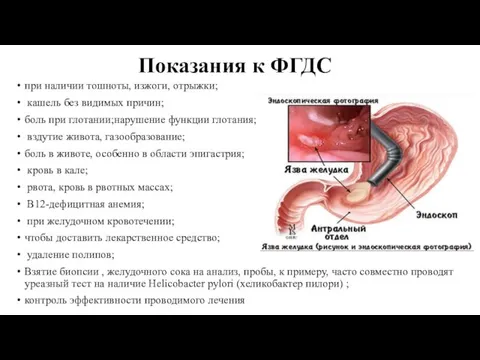 Показания к ФГДС при наличии тошноты, изжоги, отрыжки; кашель без видимых причин;