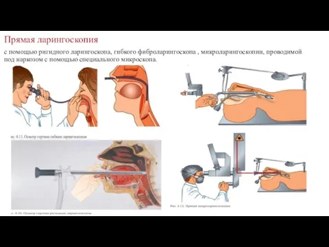 Прямая ларингоскопия с помощью ригидного ларингоскопа, гибкого фиброларингоскопа , микроларингоскопии, проводимой под