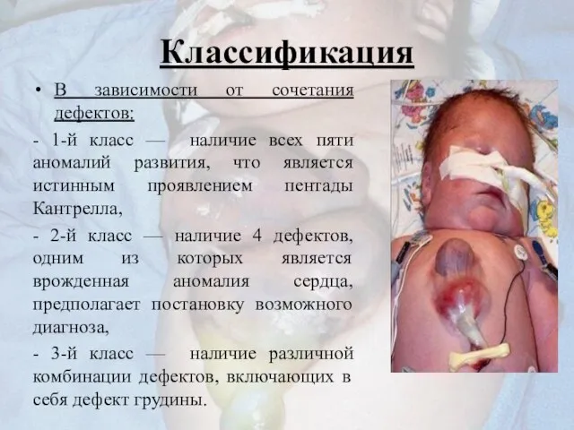 Классификация В зависимости от сочетания дефектов: - 1-й класс — наличие всех