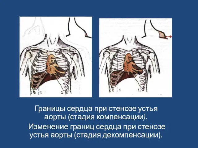 Границы сердца при стенозе устья аорты (стадия компенсации). Изменение границ сердца при