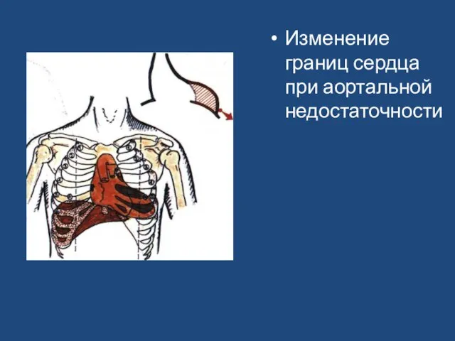 Изменение границ сердца при аортальной недостаточности