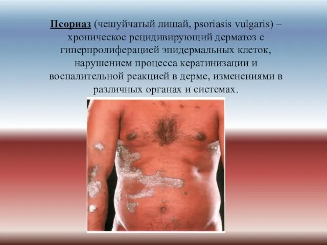 Псориаз (чешуйчатый лишай, psoriasis vulgaris) – хроническое рецидивирующий дерматоз с гиперпролиферацией эпидермальных
