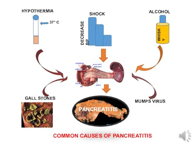 GALL STONES MUMPS VIRUS COMMON CAUSES OF PANCREATITIS PANCREATITIS