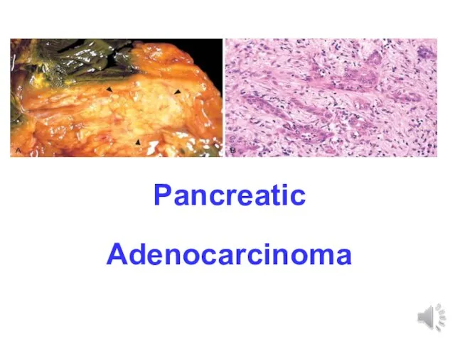 Pancreatic Adenocarcinoma