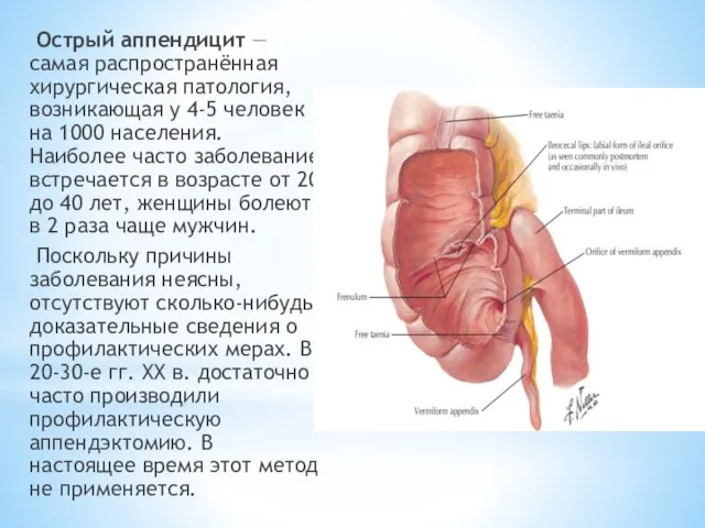 Острый аппендицит — самая распространённая хирургическая патология, возникающая у 4-5 человек на