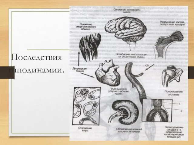 Последствия гиподинамии.