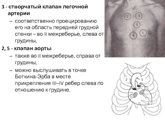 3 - створчатый клапан легочной артерии соответственно проецированию его на область передней