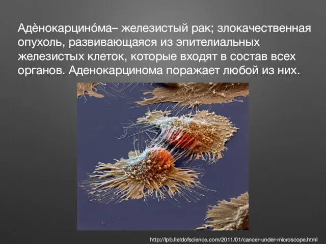 Адèнокарцинóма– железистый рак; злокачественная опухоль, развивающаяся из эпителиальных железистых клеток, которые входят