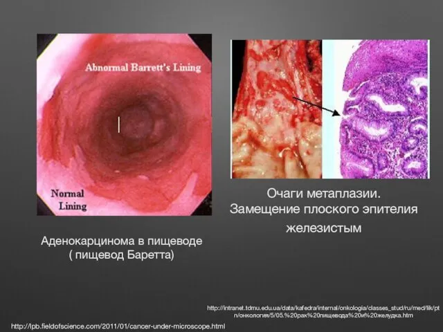 http://lpb.fieldofscience.com/2011/01/cancer-under-microscope.html Аденокарцинома в пищеводе ( пищевод Баретта) Очаги метаплазии. Замещение плоского эпителия железистым http://intranet.tdmu.edu.ua/data/kafedra/internal/onkologia/classes_stud/ru/med/lik/ptn/онкология/5/05.%20рак%20пищевода%20и%20желудка.htm