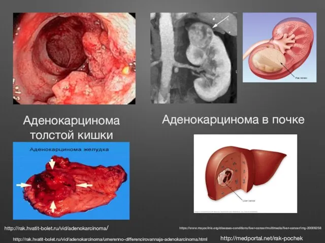 Аденокарцинома толстой кишки http://rak.hvatit-bolet.ru/vid/adenokarcinoma/umerenno-differencirovannaja-adenokarcinoma.html http://medportal.net/rak-pochek Аденокарцинома в почке http://rak.hvatit-bolet.ru/vid/adenokarcinoma/ https://www.mayoclinic.org/diseases-conditions/liver-cancer/multimedia/liver-cancer/img-20006258