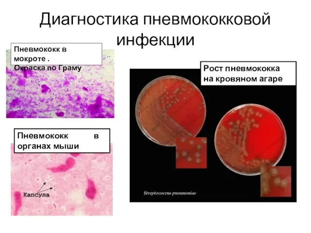 Диагностика пневмококковой инфекции Пневмококк в мокроте . Окраска по Граму Рост пневмококка