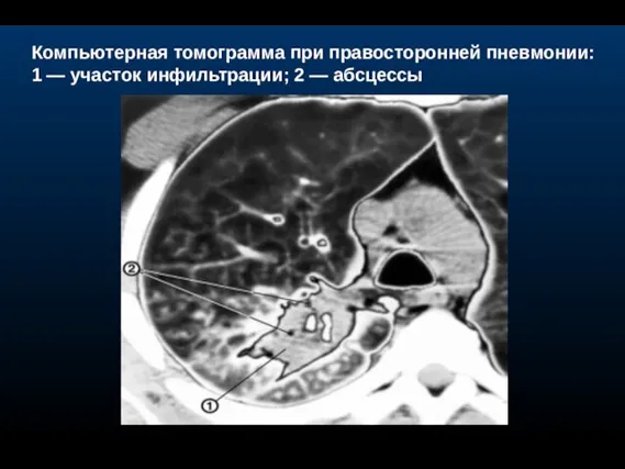 Компьютерная томограмма при правосторонней пневмонии: 1 — участок инфильтрации; 2 — абсцессы