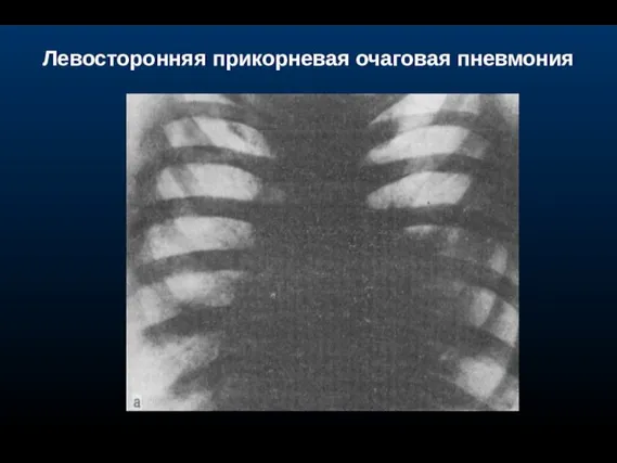 Левосторонняя прикорневая очаговая пневмония