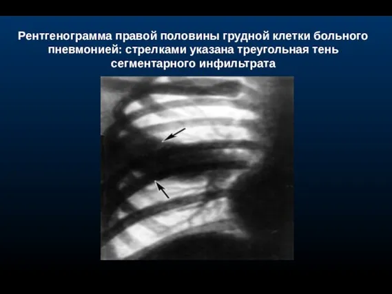 Рентгенограмма правой половины грудной клетки больного пневмонией: стрелками указана треугольная тень сегментарного инфильтрата