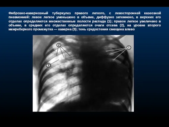 Фиброзно-кавернозный туберкулез правого легкого, с левосторонней казеозной пневмонией: левое легкое уменьшено в