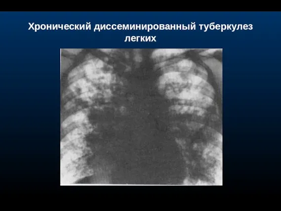 Хронический диссеминированный туберкулез легких