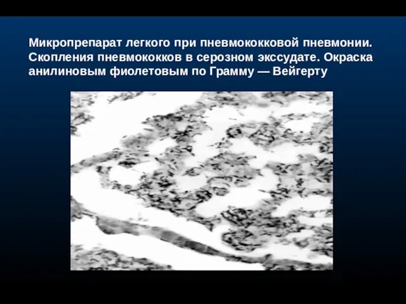 Микропрепарат легкого при пневмококковой пневмонии. Скопления пневмококков в серозном экссудате. Окраска анилиновым