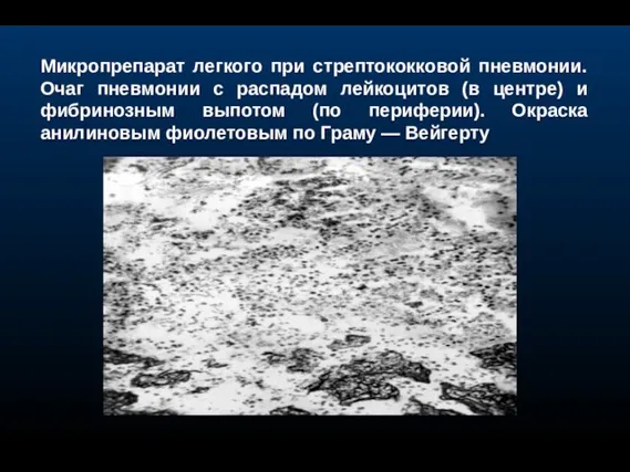 Микропрепарат легкого при стрептококковой пневмонии. Очаг пневмонии с распадом лейкоцитов (в центре)