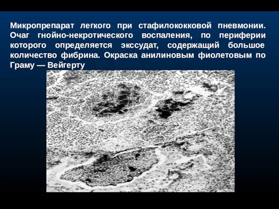 Микропрепарат легкого при стафилококковой пневмонии. Очаг гнойно-некротического воспаления, по периферии которого определяется