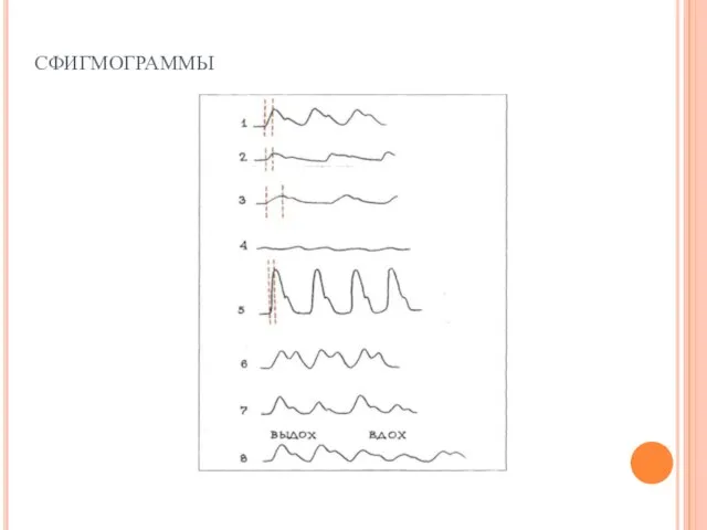сфигмограммы