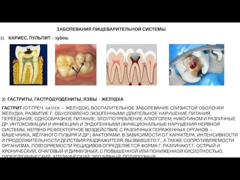 ЗАБОЛЕВАНИЯ ПИЩЕВАРИТЕЛЬНОЙ СИСТЕМЫ. КАРИЕС, ПУЛЬПИТ – зубов. 2) ГАСТРИТЫ, ГАСТРОДУОДЕНИТЫ, ЯЗВЫ -