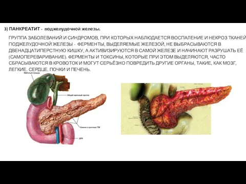 3) ПАНКРЕАТИТ - поджелудочной железы. ГРУППА ЗАБОЛЕВАНИЙ И СИНДРОМОВ, ПРИ КОТОРЫХ НАБЛЮДАЕТСЯ