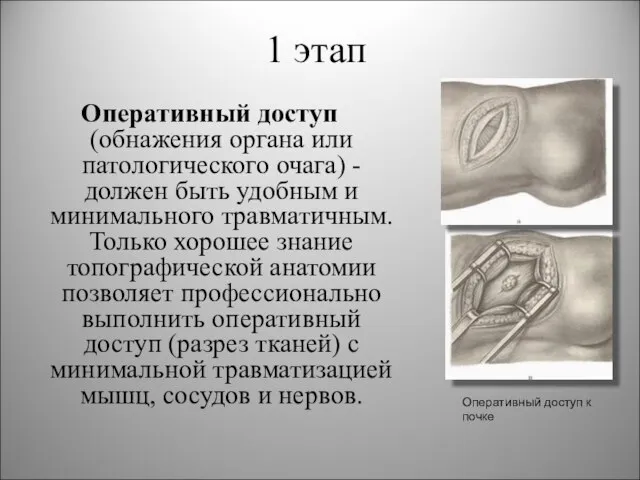 1 этап Оперативный доступ (обнажения органа или патологического очага) - должен быть