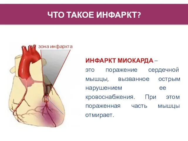 ЧТО ТАКОЕ ИНФАРКТ? ИНФАРКТ МИОКАРДА – это поражение сердечной мышцы, вызванное острым