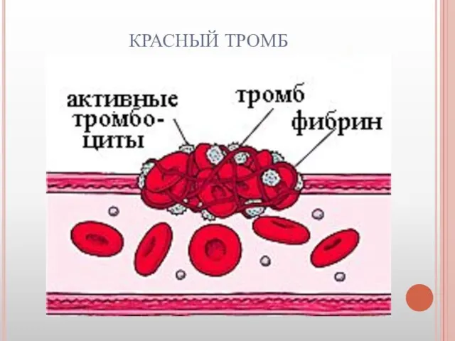 КРАСНЫЙ ТРОМБ