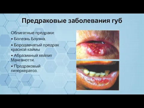 Предраковые заболевания губ Облигатные предраки: • Болезнь Боуэна. • Бородавчатый предрак красной
